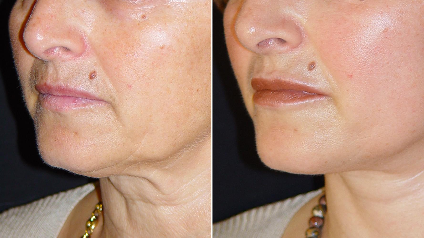 Antes e depois Micro-lift