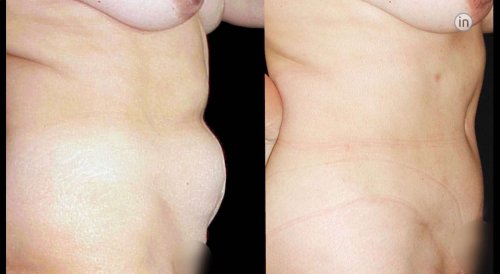 Antes e depois abdominoplastia