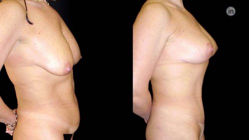 Antes e depois abdominoplastia