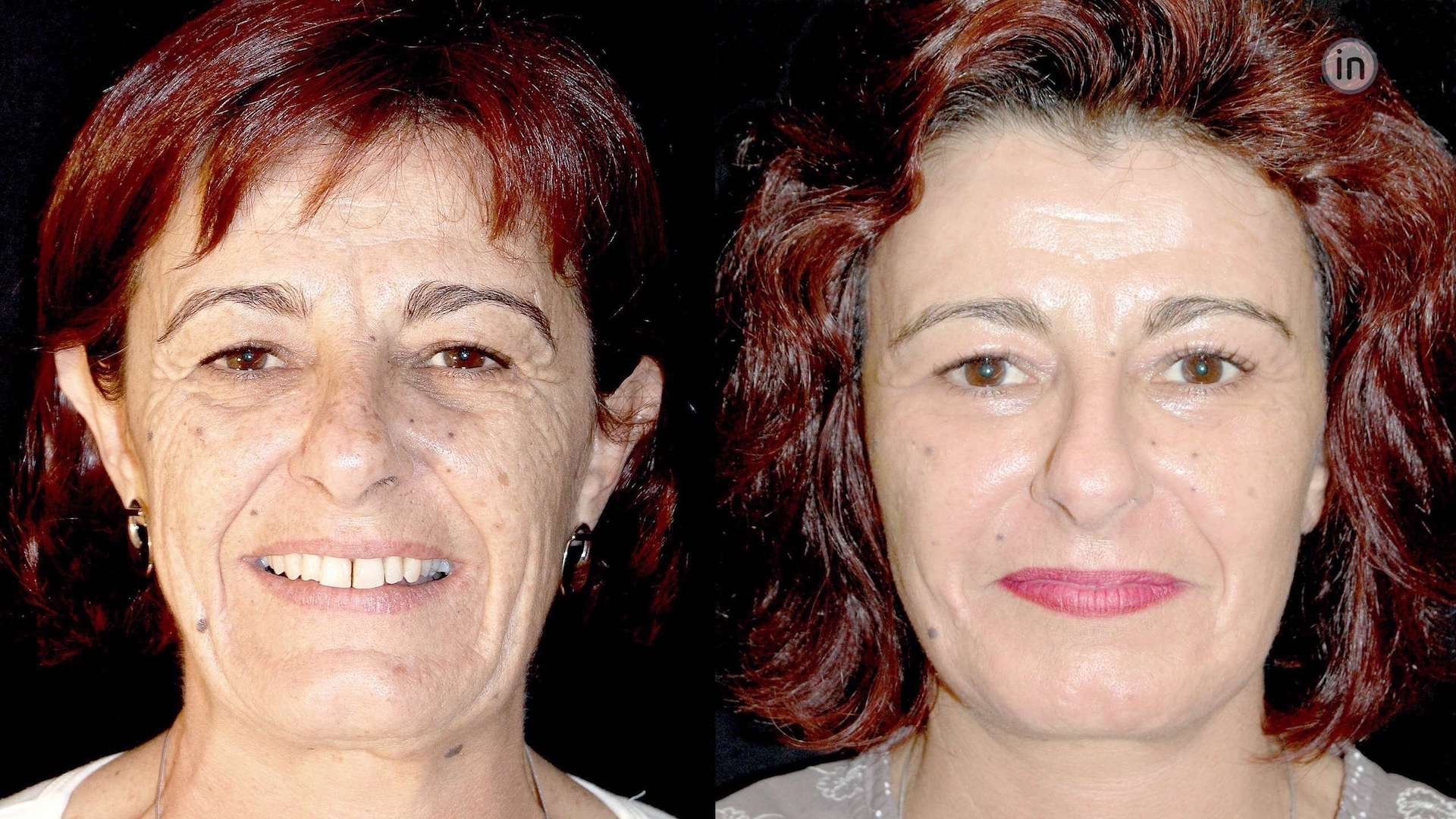 Face lift - Pré e Pós Operatório - Cirurgia Plástica