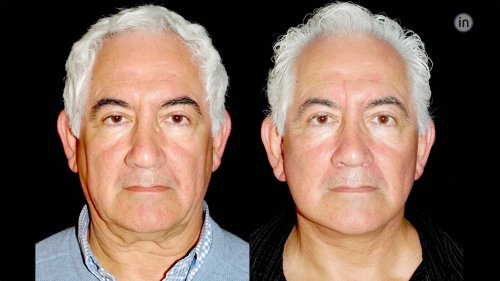 Antes e depois Face-lift