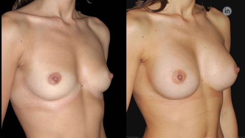 Antes e depois mamoplastia de aumento