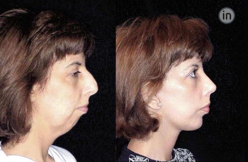 Antes e depois rinoplastia e mentoplastia