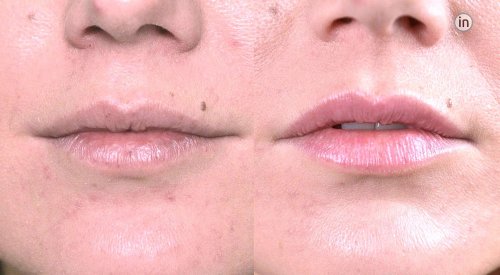 Antes e depois tratamento dos lábios